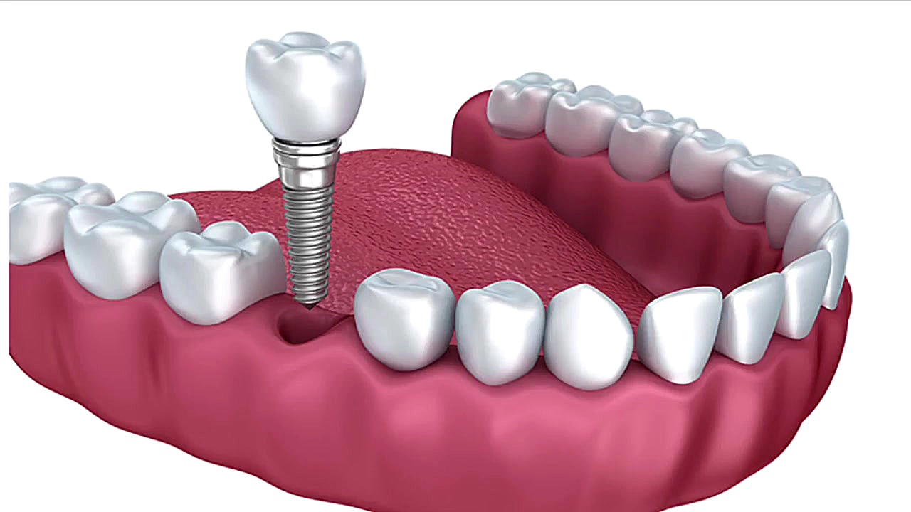 ویژگی های بهترین متخصص ایمپلنت دندان در تهران کلینیک دندانپزشکی دکتر عزیز گشاده رو