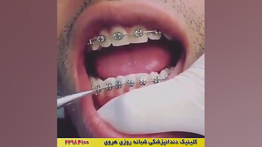 ارتودنسی دندان / سیم کشی دندان ها پزشکی درد مداوم