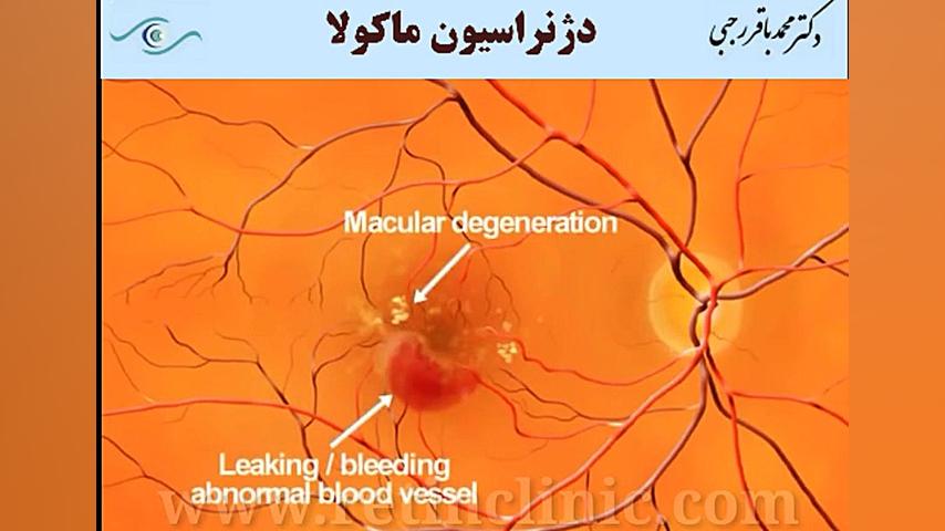 دژنراسیون ماکولا دکتر محمد باقر رجبی -فوق تخصص شبکیه و لیزر