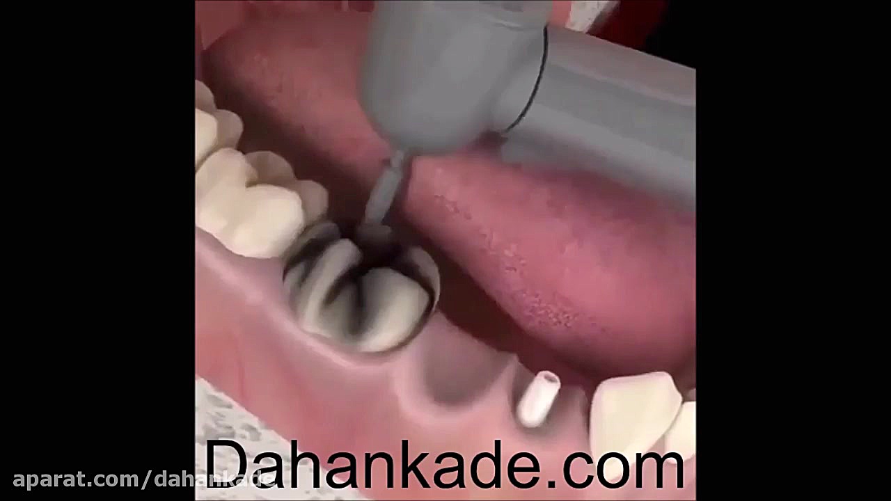 نحوه ایمپلنت، ترمیم و بریدج دندان پزشکی ژنراتور پالس عصبی