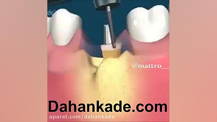 ترمیم دندان آسیب دیده و قرار دادن روکش کربتوزوماب