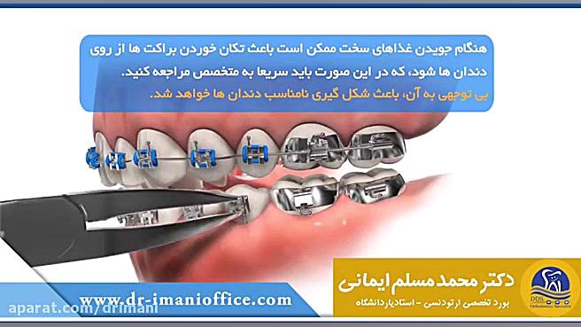 جویدن غذاهای سخت در ارتودنسی دکتر محمد مسلم ایمانی - متخصص ارتودنسی در کرمانشاه