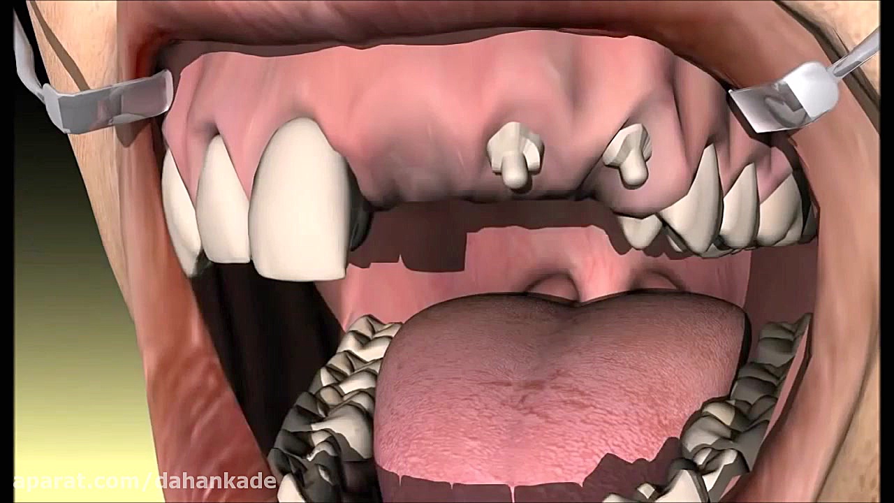 نحوه ترمیم و باز سازی دندان های توسط گذاشتن بریج Apoptosis Pathway Analysis