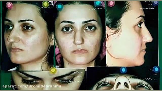 نمونه کار بهترین جراح بینی تهران، دکتر امید ابراهیمی دکتر امید ابراهیمی