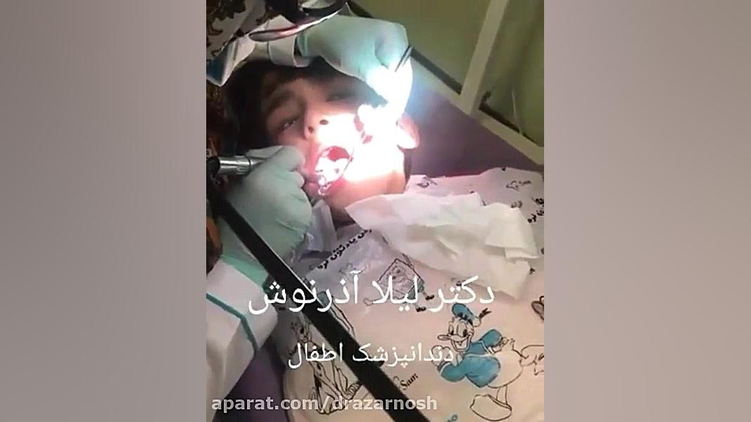 پر کردن دندان کودکان هایپرپاراتیروئیدیسم