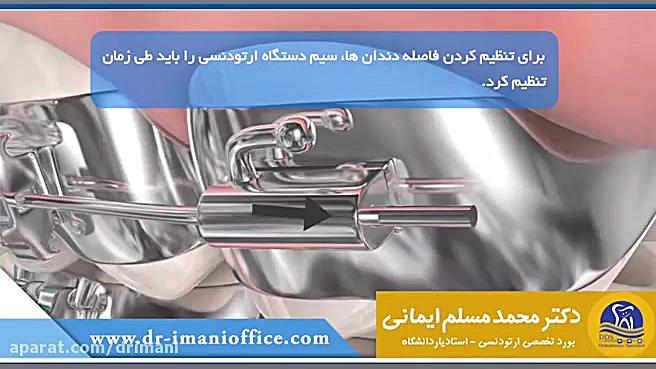 استفاده از موم ارتودنسی دکتر محمد مسلم ایمانی - متخصص ارتودنسی در کرمانشاه