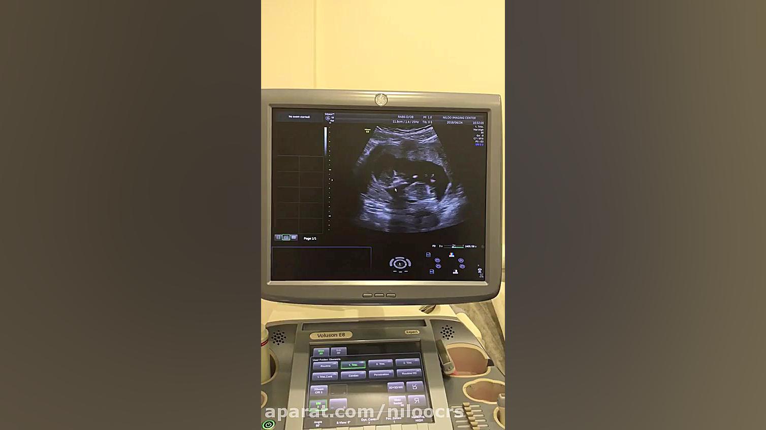 سونوگرافی بارداری - بیوفیزیکال پروفایل 01 سونوگرافی نیلو دکتر فاطمه مهتاب قربانی