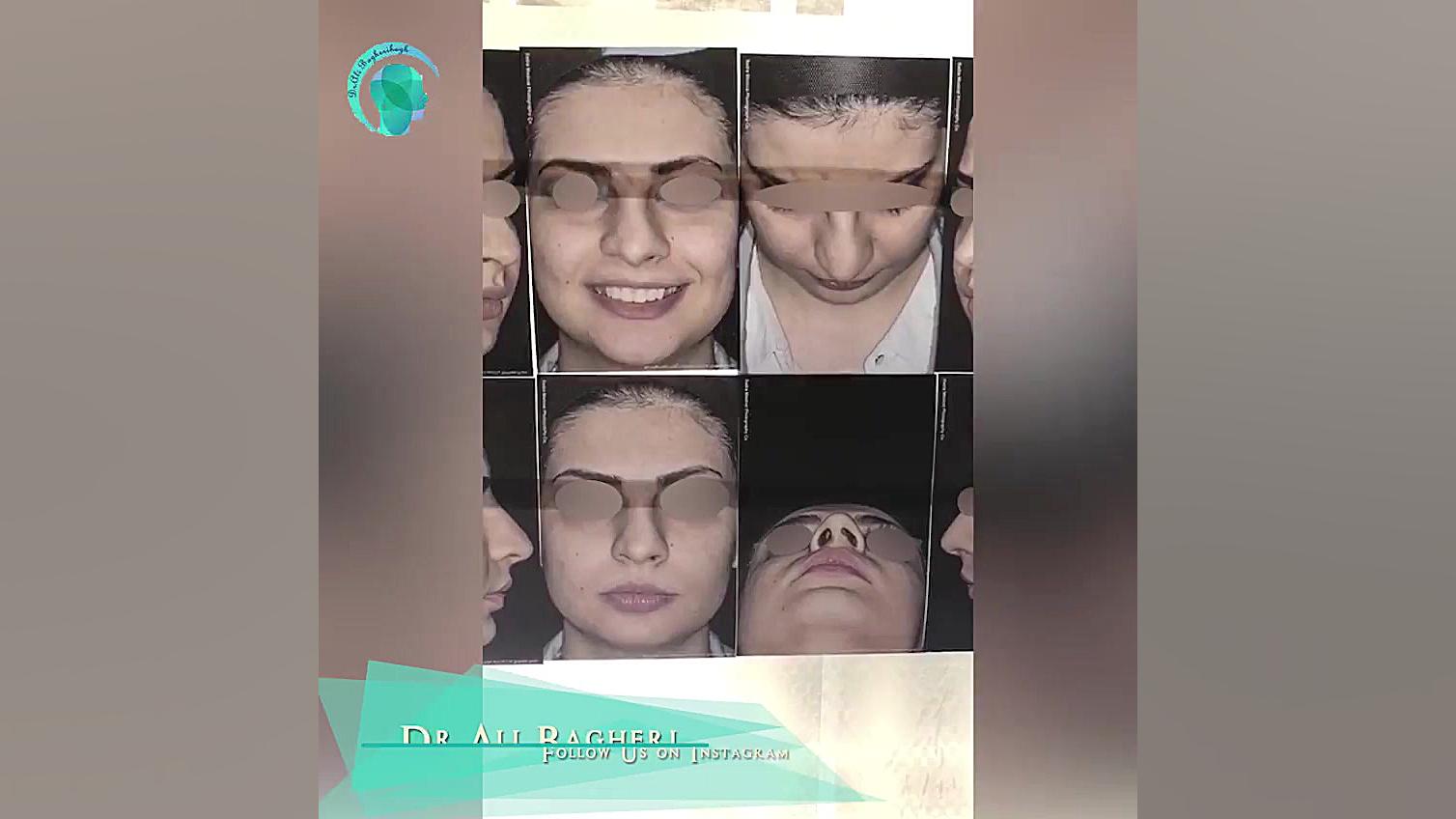 نمونه عمل جراحی بینی دکتر علی باقری حق