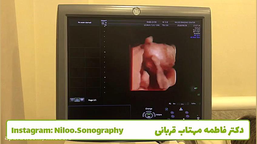سونوگرافی جنین - ورم کلیه ها سونوگرافی نیلو دکتر فاطمه مهتاب قربانی