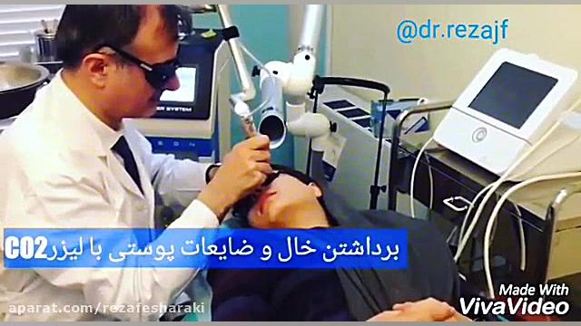 برداشتن خال و ضایعات پوستی با لیزر CO2 دکتر رضا جعفری فشارکی- متخصص پوست و مو