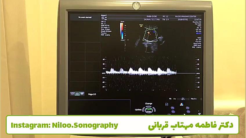 سونوگرافی جنین - داپلر سونوگرافی نیلو دکتر فاطمه مهتاب قربانی