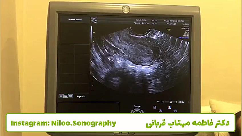 سونوگرافی رحم - واژینال سونوگرافی نیلو دکتر فاطمه مهتاب قربانی