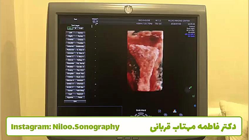 سونوگرافی رحم - سه بعدی سونوگرافی نیلو دکتر فاطمه مهتاب قربانی
