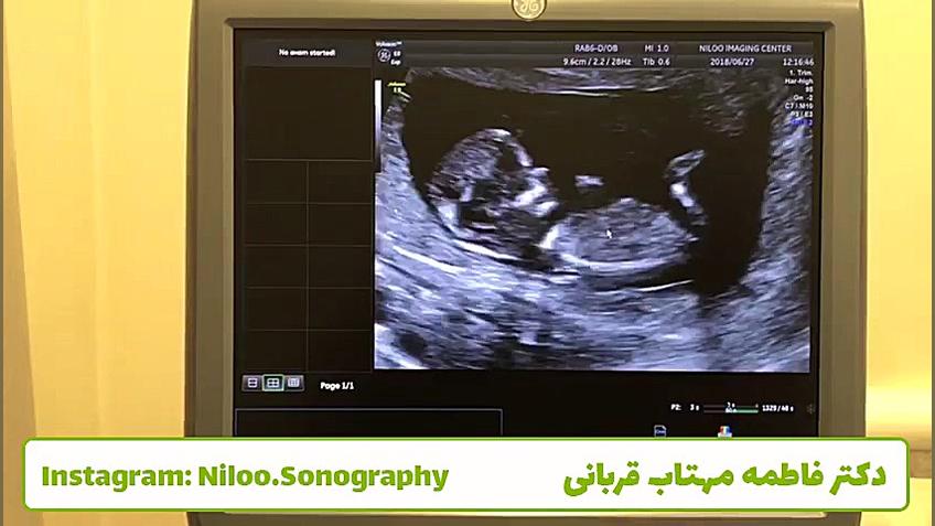 سونوگرافی جنین - غربالگری اول سونوگرافی نیلو دکتر فاطمه مهتاب قربانی