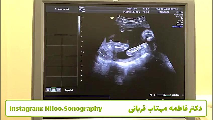 سونوگرافی جنین - غربالگری دوم سونوگرافی نیلو دکتر فاطمه مهتاب قربانی
