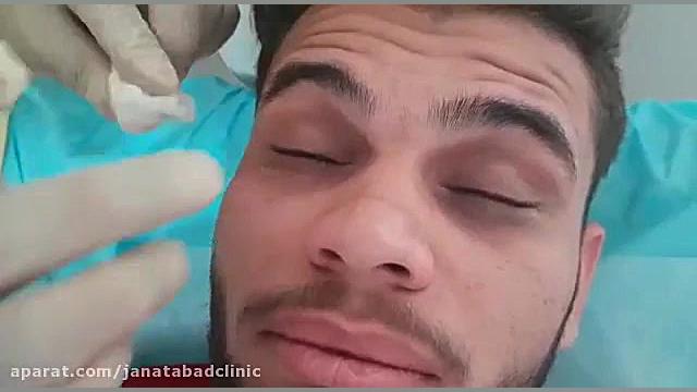 مزوتراپی و فیلرهمزمان بیورآکتور سه‌بعدی