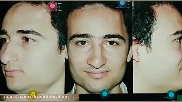 نمونه کار بهترین جراح بینی تهران، دکتر امید ابراهیمی دکتر امید ابراهیمی