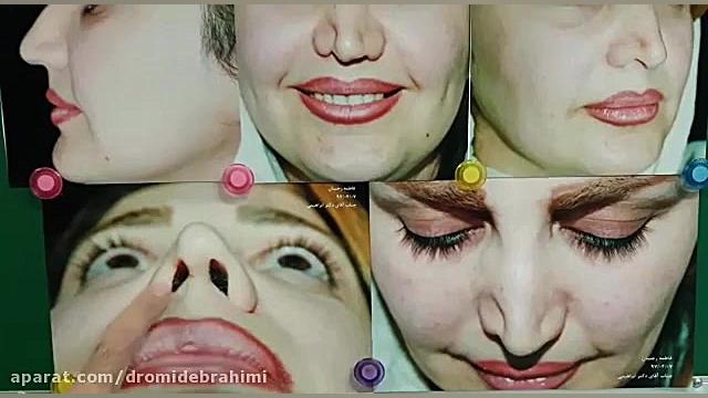 نمونه کار بهترین جراح بینی تهران، دکتر امید ابراهیمی دکتر امید ابراهیمی