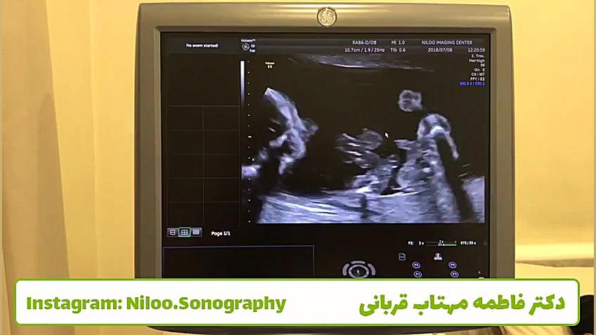 سونوگرافی جنین - انگشتان دست در سونوی 2 بعدی پیلینگ شیمیایی