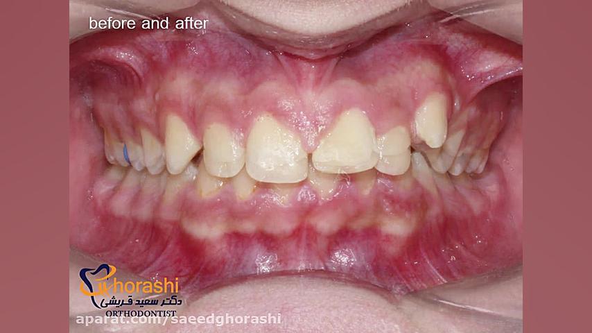 نمونه کار قبل و بعد ارتودنسی-دکتر سعید قریشی دکتر سعید قریشی