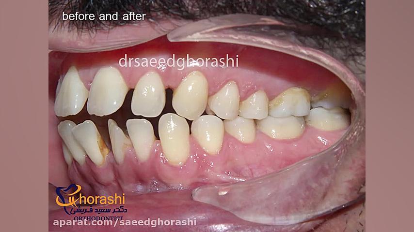نمونه کار قبل و بعد ارتودنسی-دکتر سعید قریشی دکتر سعید قریشی