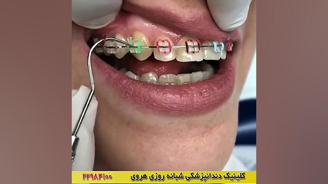 کش های رنگی ارتودنسی دندان هیدروپس فتالیس