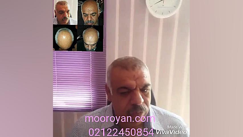 دیگر نیازی به کاشت مو نیست اولین بار در ایران در کلینیک پوست مو زیبایی مورویان TAVI