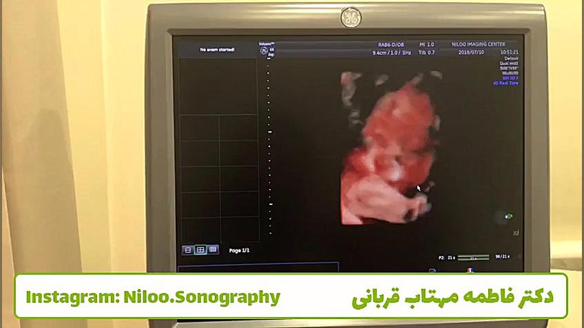 سونوگرافی جنین - 31 هفته سونوگرافی نیلو دکتر فاطمه مهتاب قربانی