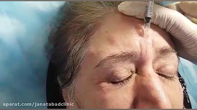 تزریق بوتاکس نپتوکلیب