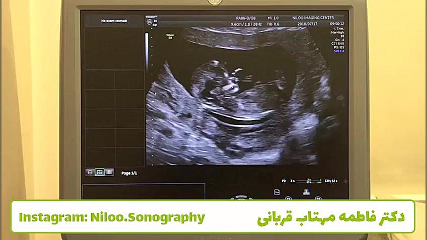 سونوگرافی جنین - دست در بینی! سونوگرافی نیلو دکتر فاطمه مهتاب قربانی
