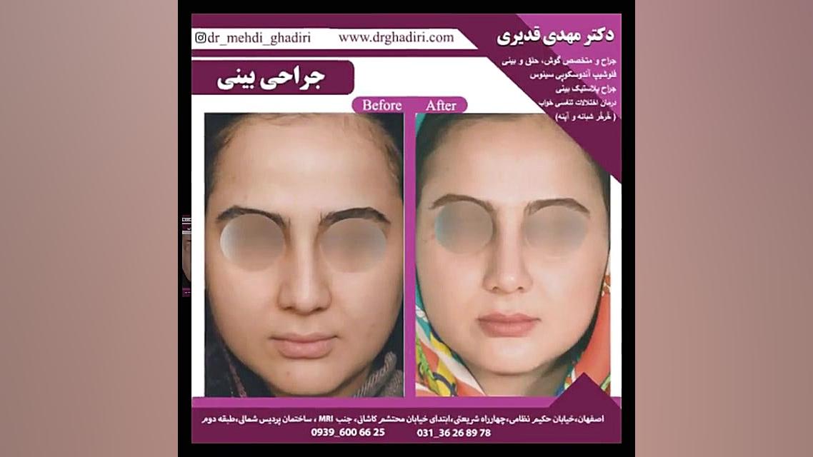 نمونه های جراحی بینی دکتر مهدی قدیری دکتر مهدی قدیری