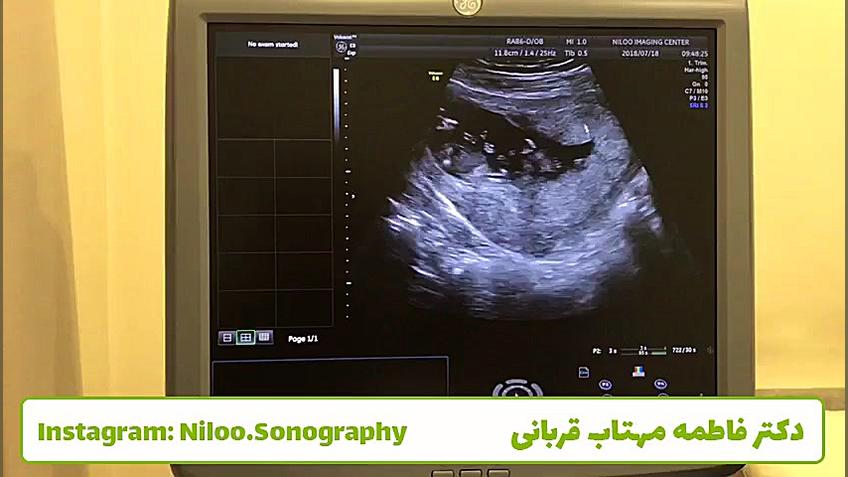 سونوگرافی جنین - دوقلوهای همسان سونوگرافی نیلو دکتر فاطمه مهتاب قربانی