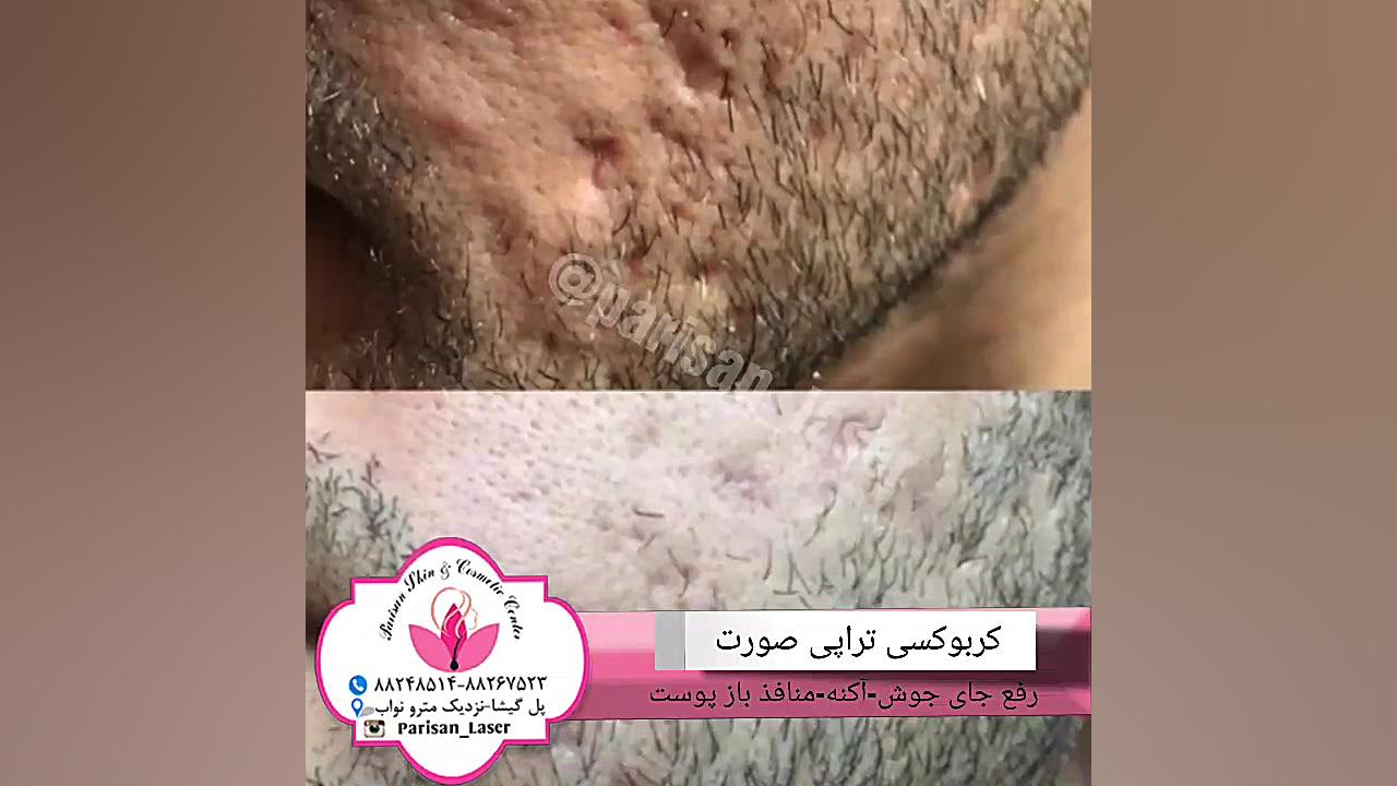 کربوکسی تراپی صورت/مرکز لیزر و زیبایی پری سان ترمیم دندان
