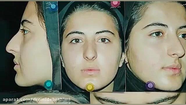 نمونه کار بهترین جراح بینی تهران، دکتر امید ابراهیمی دکتر امید ابراهیمی