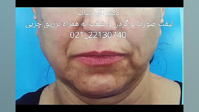 لیفت صورت و گردن به همراه تزریق چربی هالوسیناتوری بویایی