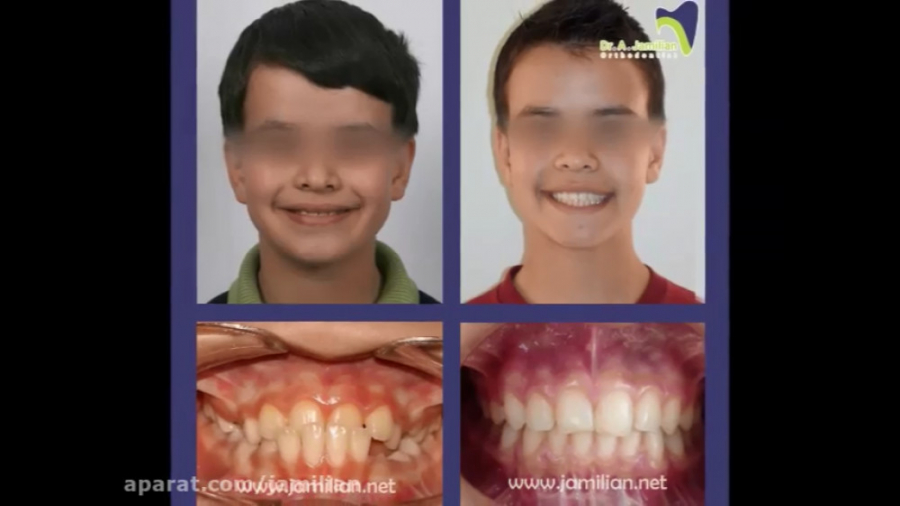 قبل و بعد ارتودنسی نمونه کارهای دکتر جمیلیان دکتر عبدالرضا جمیلیان - متخصص ارتودنسی