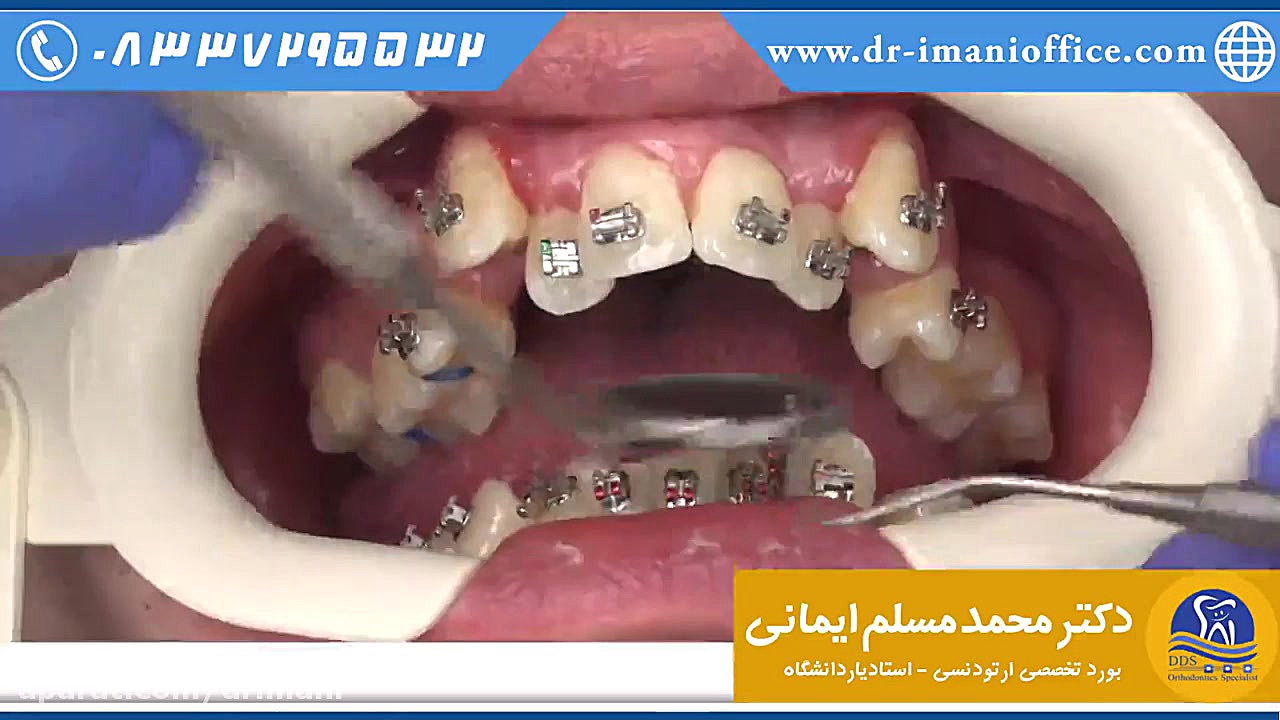مراحل باندینگ (چسباندن براکت ها روی دندان) دکتر محمد مسلم ایمانی - متخصص ارتودنسی در کرمانشاه