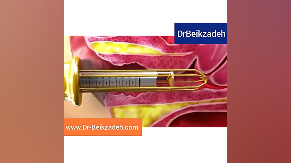 تنگ کردن واژن با لیزر - دکتر مژگان بیک زاده دکتر مژگان بیک زاده ( جراح و متخصص زنان و زایمان)
