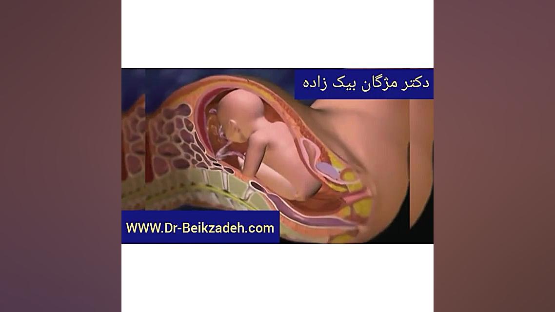 نحوه انجام سزارین - دکتر مژگان بیک زاده دکتر مژگان بیک زاده ( جراح و متخصص زنان و زایمان)