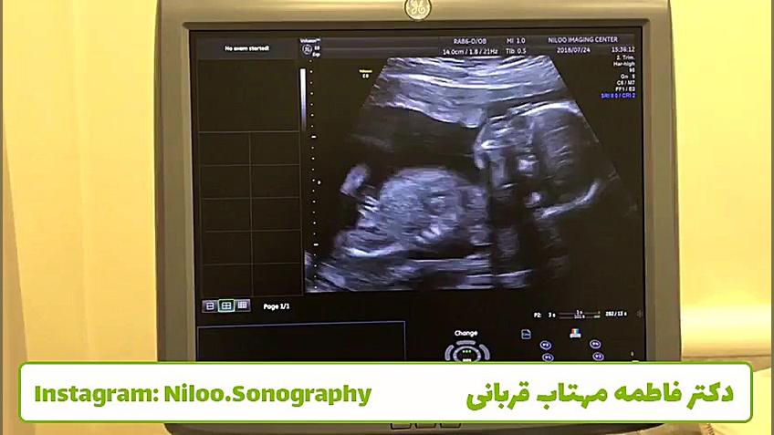 سونوگرافی جنین - فیبروم بارداری سونوگرافی نیلو دکتر فاطمه مهتاب قربانی
