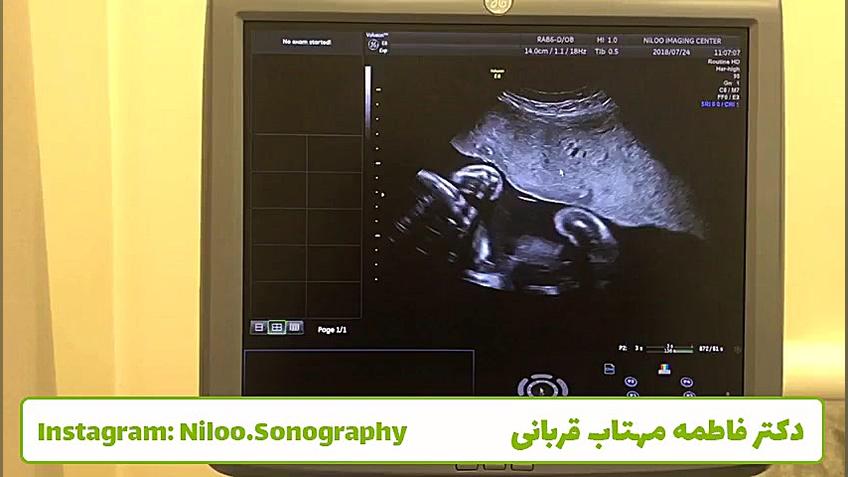 سونوگرافی جنین - تک جفتی بودن جنین دوقلو سونوگرافی نیلو دکتر فاطمه مهتاب قربانی