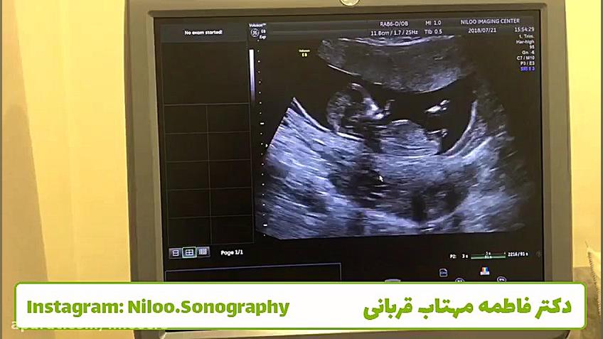سونوگرافی رحم - هماتوم کلاغ آنلاین
