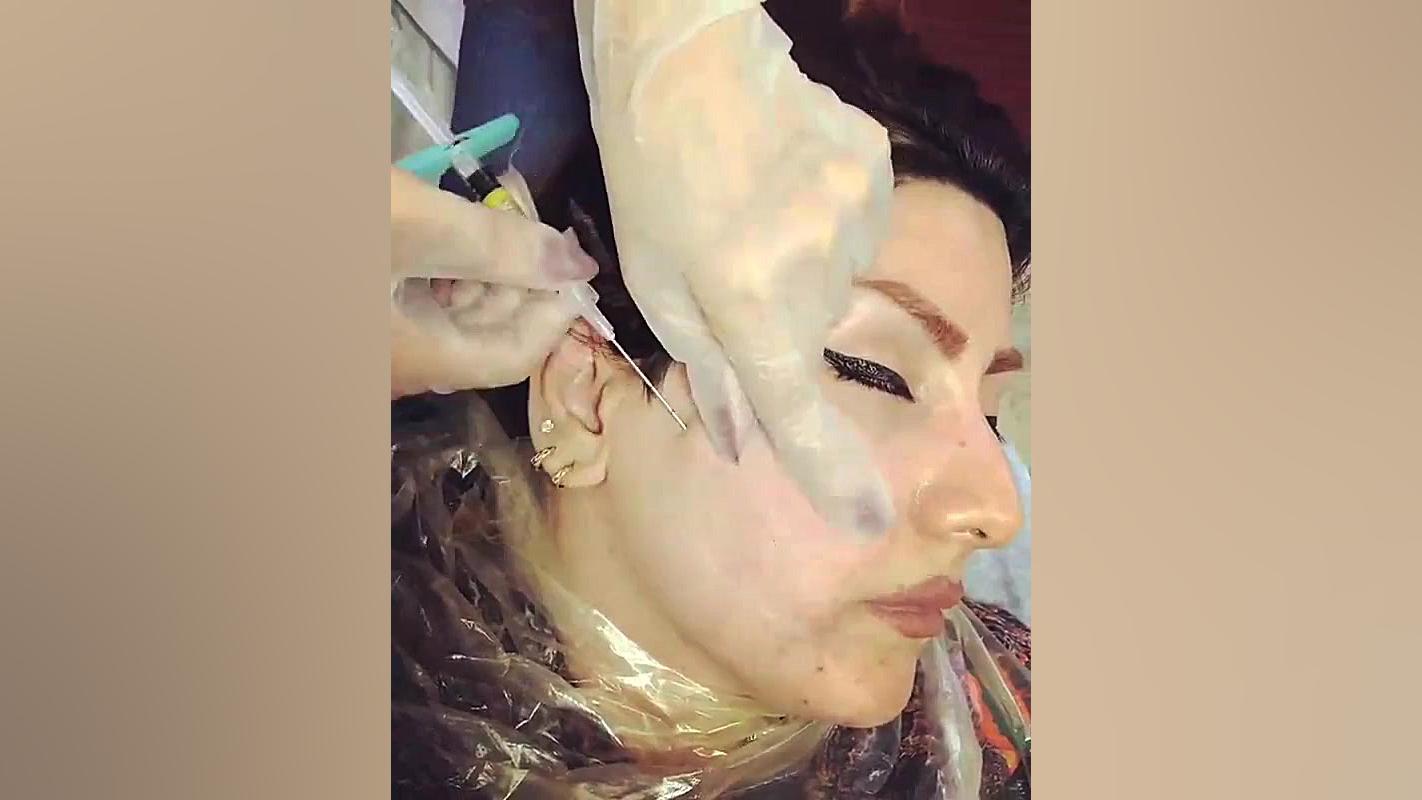 سابسیژن جای جوش همراه با تزریق ژل-موگه کلینیک دستگاه فیبر نوری جراحی