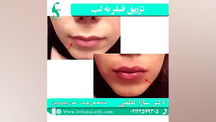 تزریق فیلر به لب دکتر سار ا لطفی