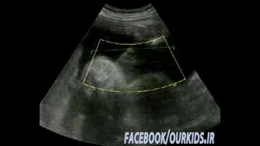 سونوگرافی 3 بعدی از جنین داخل رحم Www.ourkids.ir علیرضا طلیسچی