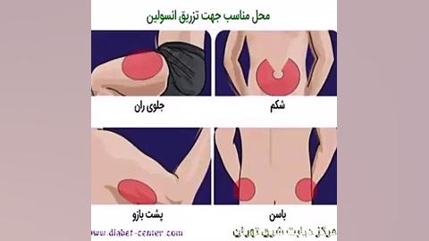 چگونه انسولین خود را تزریق کنیم ؟ | انجمن دیابت شرق دکتر پوست