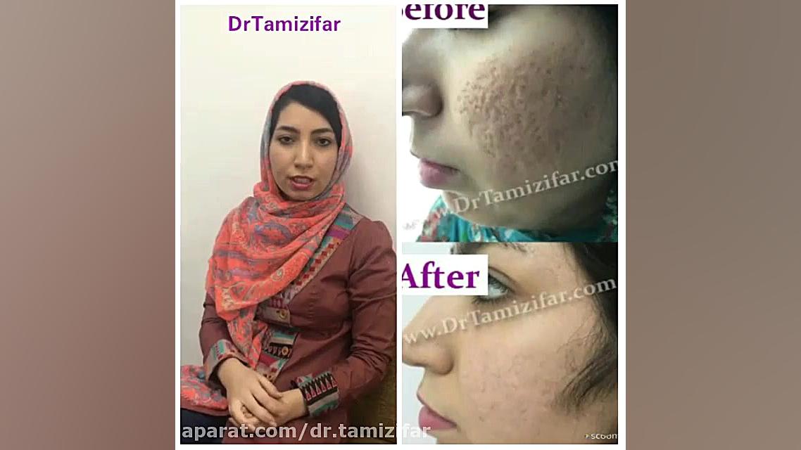 نمونه کار درمان جای جوش دکتر بنفشه تمیزی فر