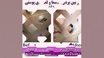 نمونه کار درمان جای جوش دکتر بنفشه تمیزی فر