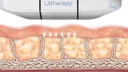هایفوتراپی اصلاح طرح لبخند