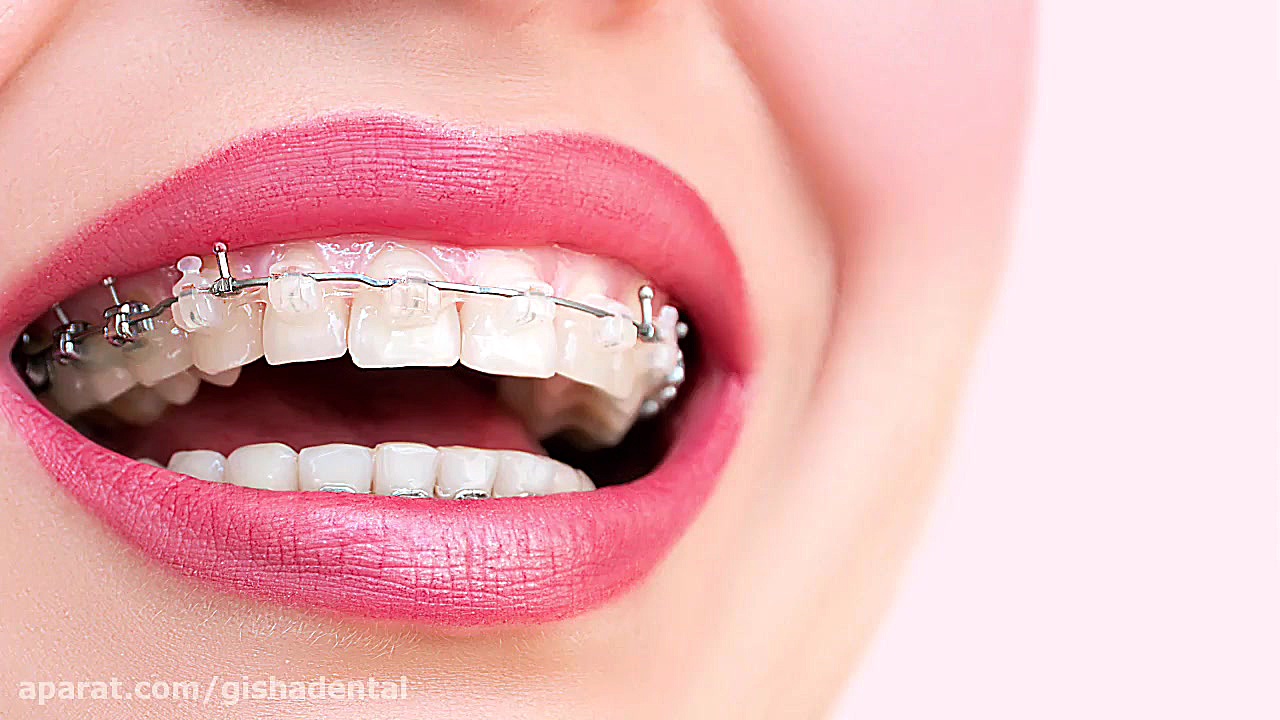 ارتودنسی ثابت توسط متخصص ارتودنسی خوب در غرب تهران کلینیک دندانپزشکی دکتر عزیز گشاده رو